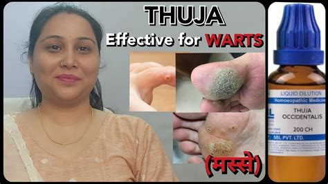Please don&x27;t give the doses daily. . Thuja 1m dosage for warts